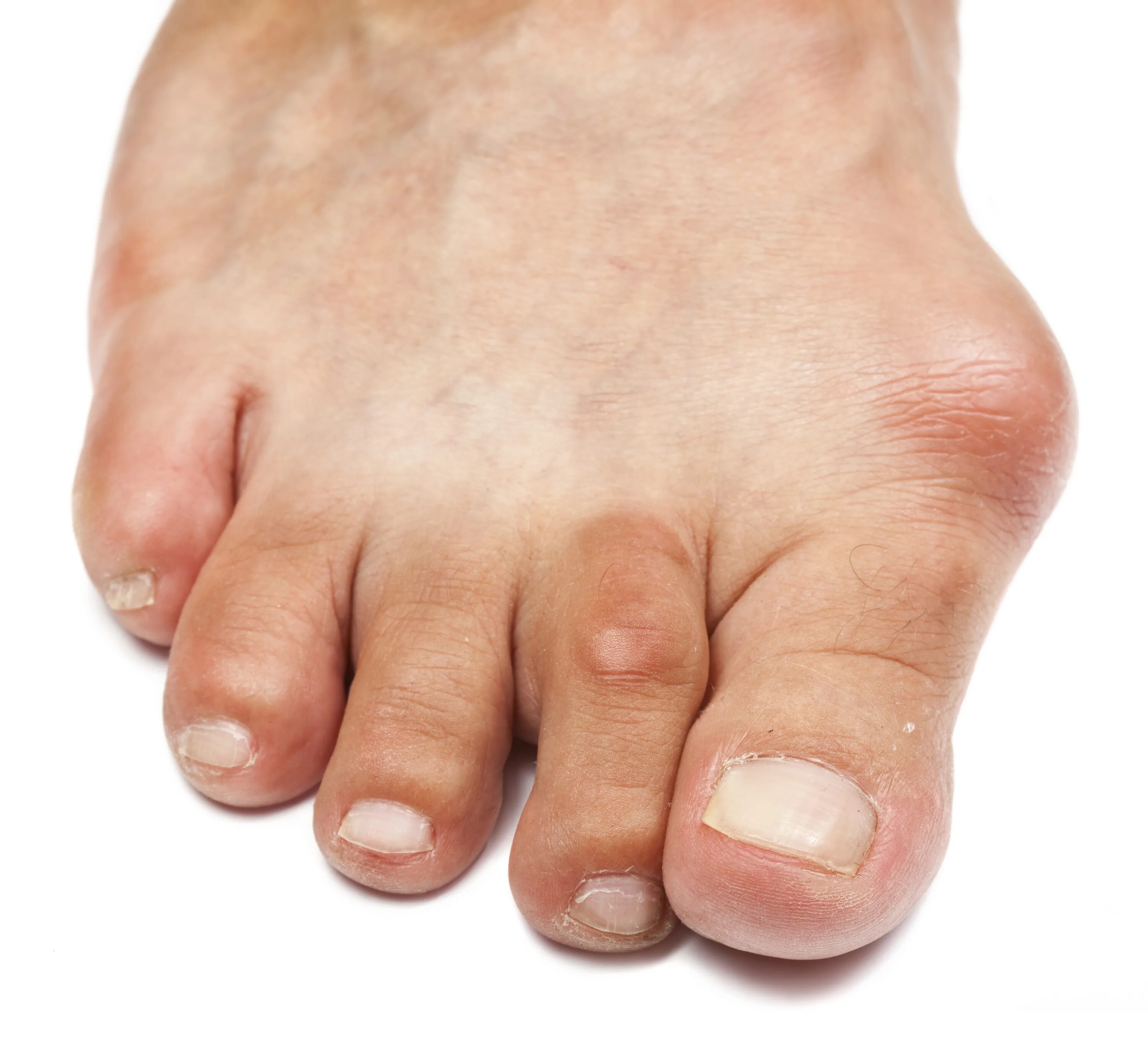 Подагрический артрит симптомы фото What your FEET say about your health - from cracked heels to bunions The US Sun