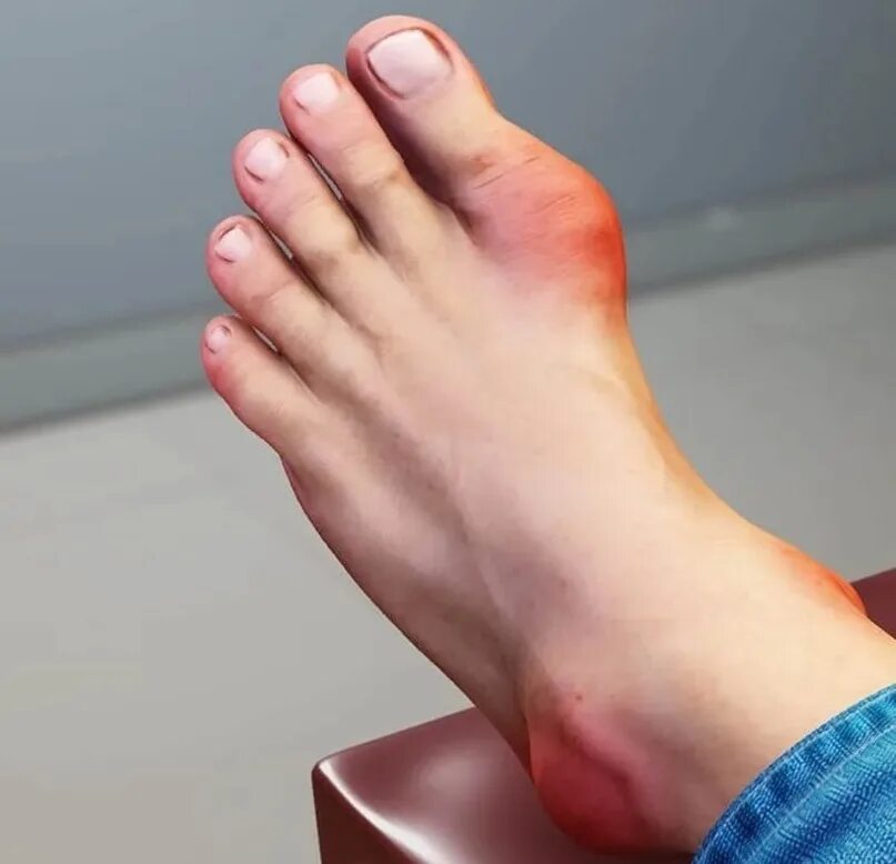 Подагрический артрит симптомы фото Orthodox conspiracy against gout: It is necessary to melt the bath well (the mai