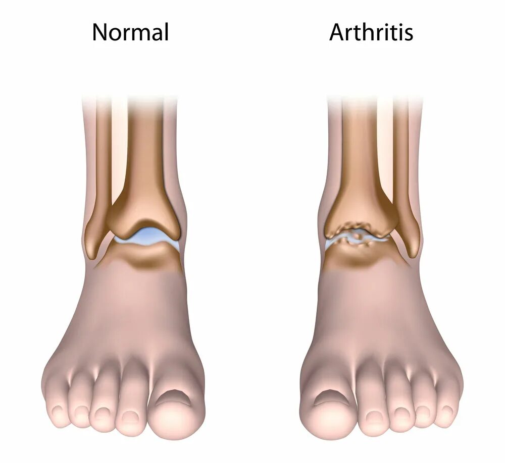 Подагрический артрит симптомы фото и лечение Ankle Osteoarthritis: Symptoms, Causes, Treatment By Ankle Braces