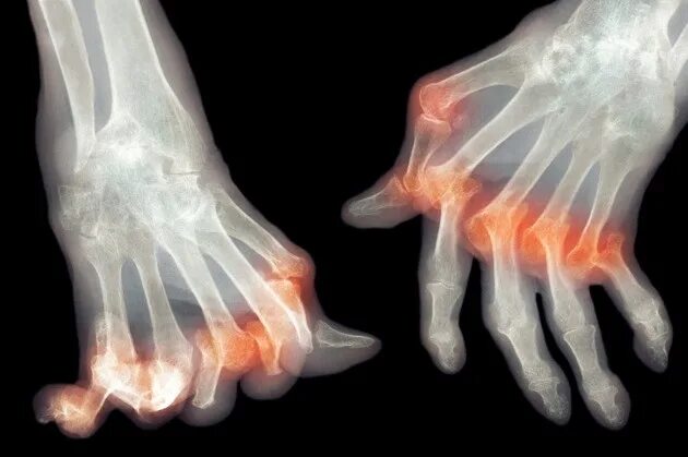 Подагрический артрит симптомы фото и лечение Drug companies flock to supercharged T-cells in fight against autoimmune disease