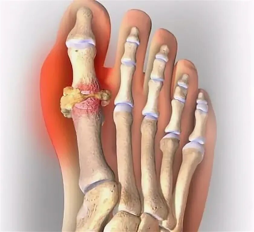 Подагрический артрит симптомы фото и лечение Gout - Signs, Symptoms, and Treatment in Men and Women