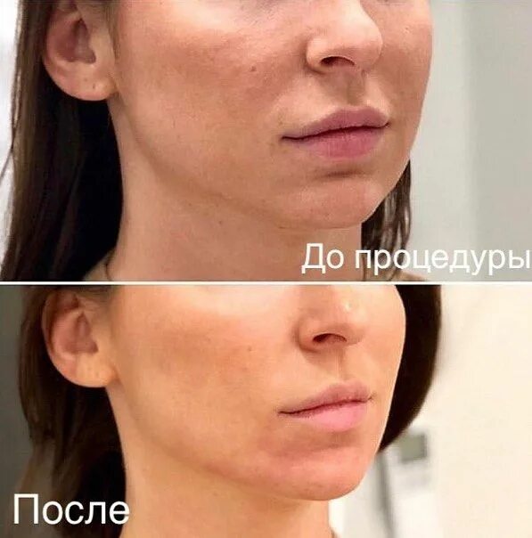 Подбородок филлерами фото до и после Аппаратные процедуры дают быстрый и продолжительный эффект, который заметен уже 