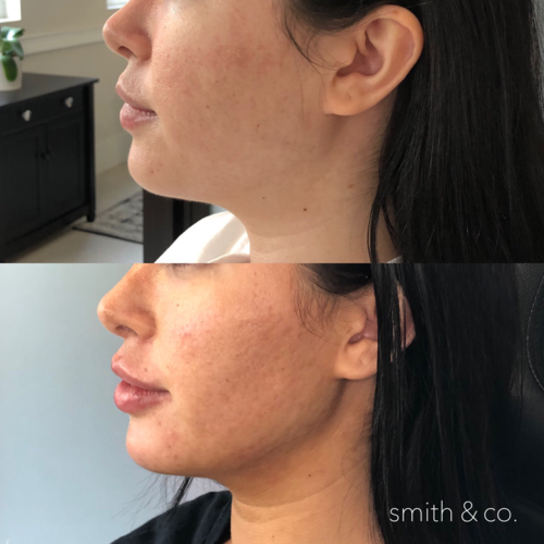 Подбородок филлерами фото до и после smith & co best chin filler cheek filler lip injections in miami best botox spec