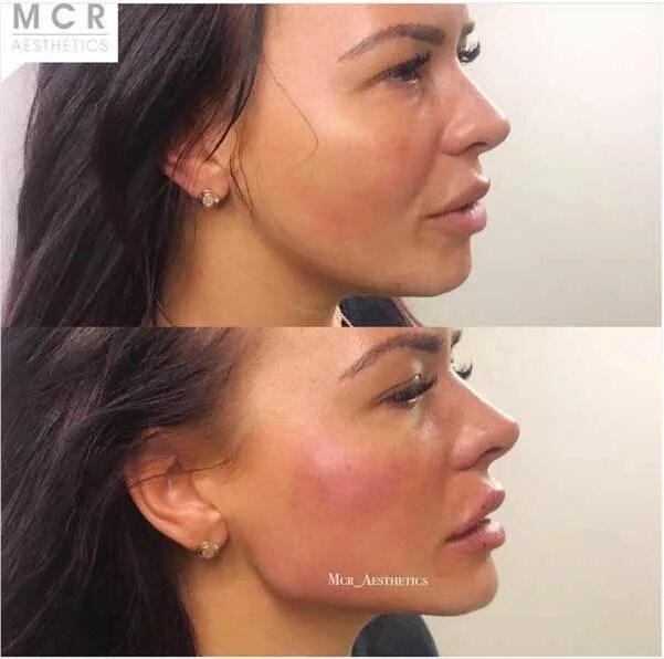 Подбородок филлерами фото до и после How to Use Chin Fillers to give Angulairity and a better Jawline to a Round Face