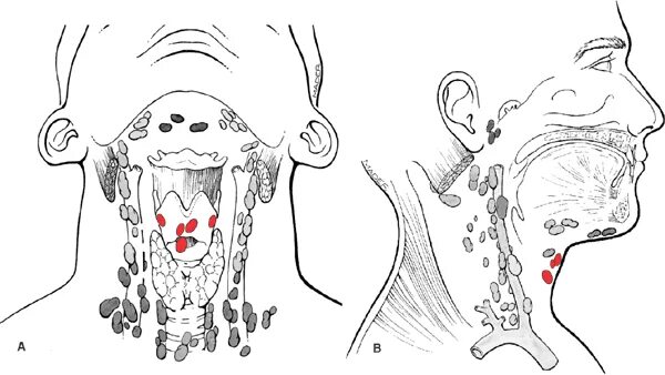 Подчелюстные лимфоузлы расположение схема Glottic Cancer Lymph Nodes