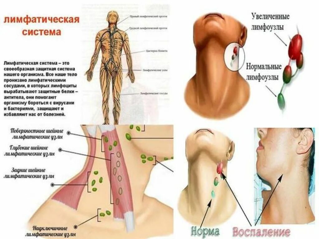 Подчелюстные лимфоузлы расположение схема Измененные лимфатические узлы