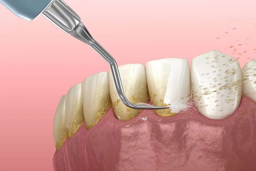 Поддесневой камень фото What is dental scaling? All kinds of methods! - SERENITY Clinic Dubai Marina