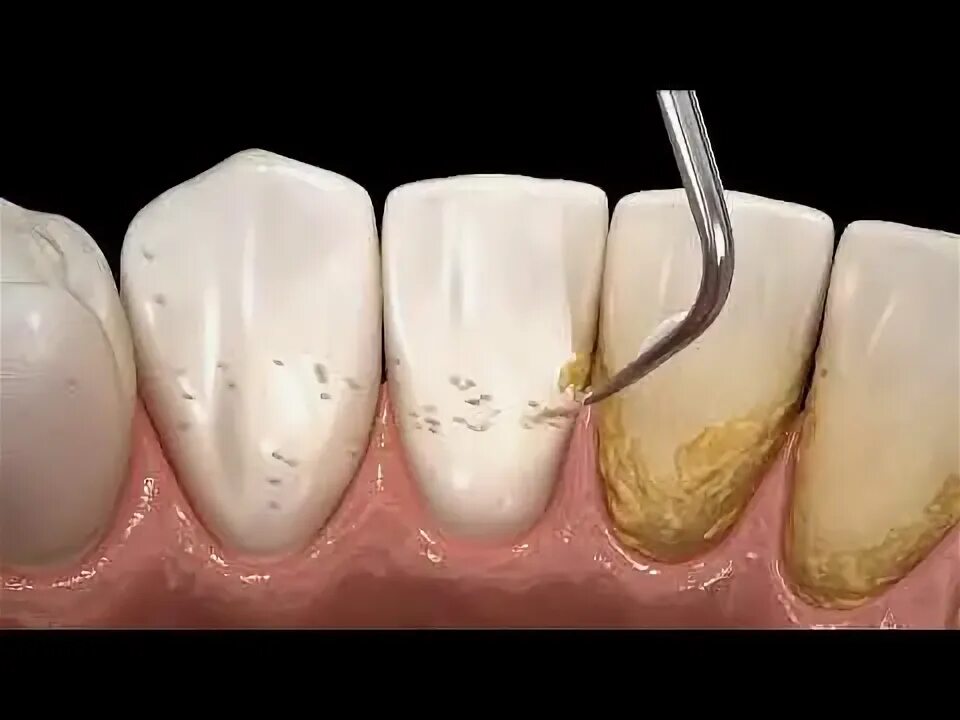 Поддесневой камень фото Why do I need a Teeth Cleaning? - YouTube