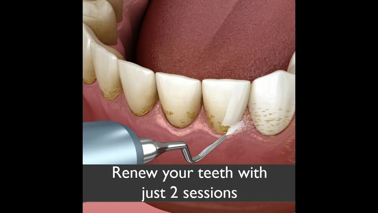 Поддесневой зубной камень как выглядит How to remove Tartar from your Teeth - SpaClean White Ultrasonic Calculus Remova