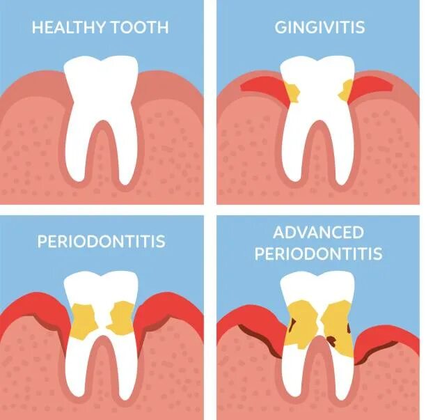 Поддесневой зубной камень как выглядит Более 1 000 работ на тему "Dental Office Posters": стоковые фото, картинки и изо