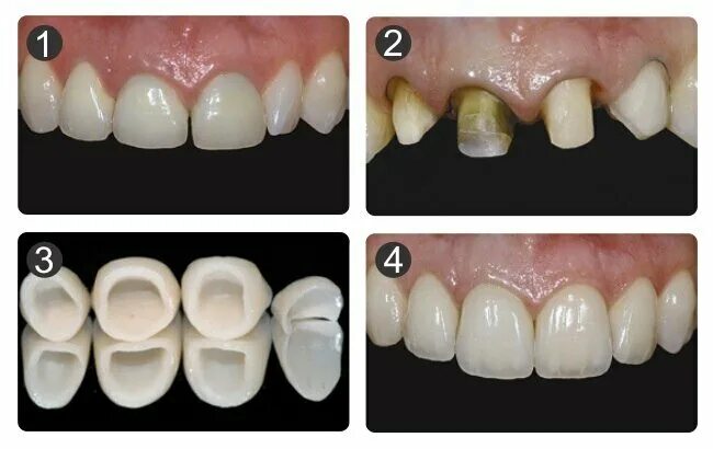 Подготовка зубов к винирам фото Vashstomatolog, dental clinics, Russia, Velikiy Novgorod, Vostochnaya ulitsa, 15