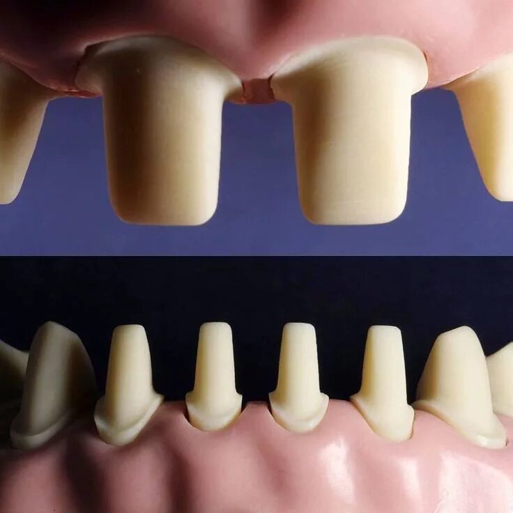 Подготовка зубов к винирам фото Crown preparation for full zirconia or porcelain fused to metal (PFM) crowns Ele