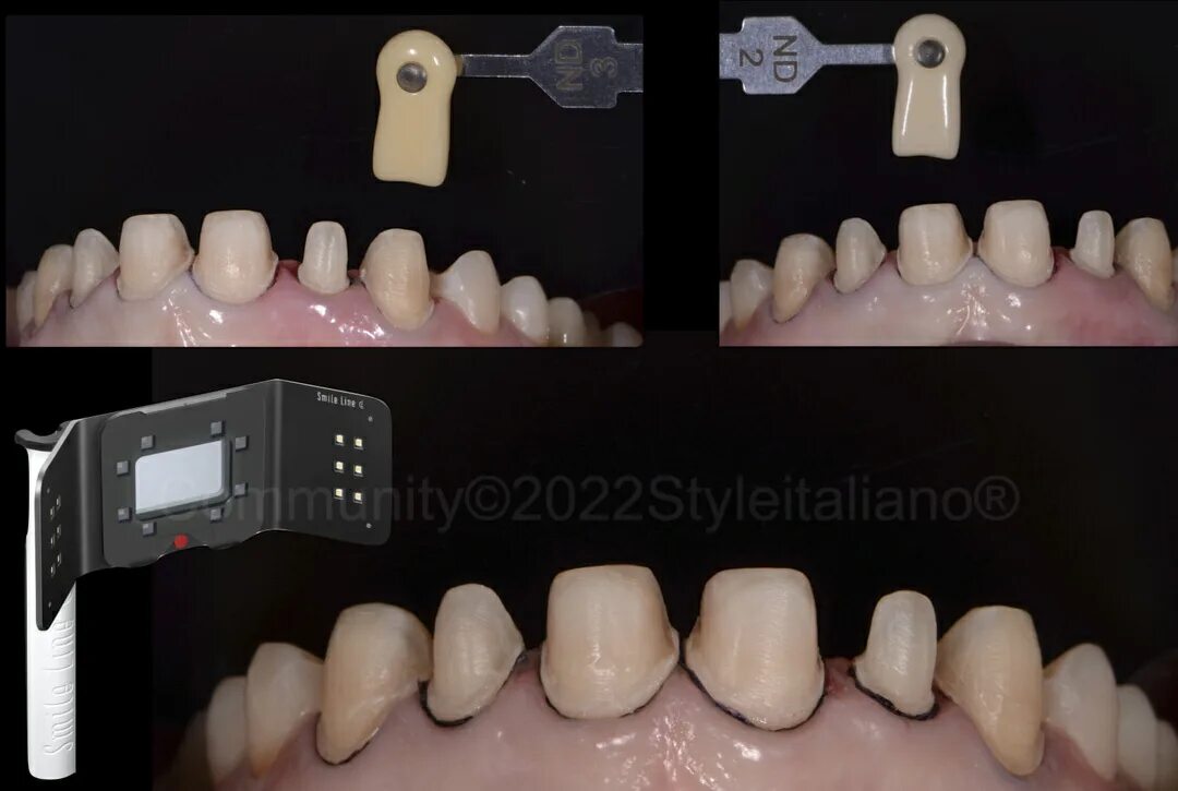Подготовка зубов к винирам фото Complete Digital Work Flow for Laminate Veneers - Styleitaliano.org