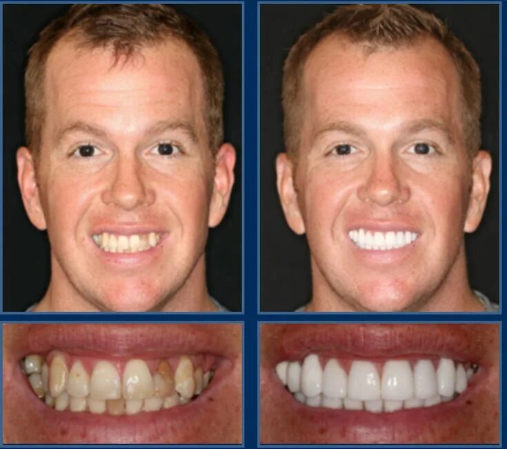 Подготовка зубов к винирам фото Pin on Cosmetic Dentistry