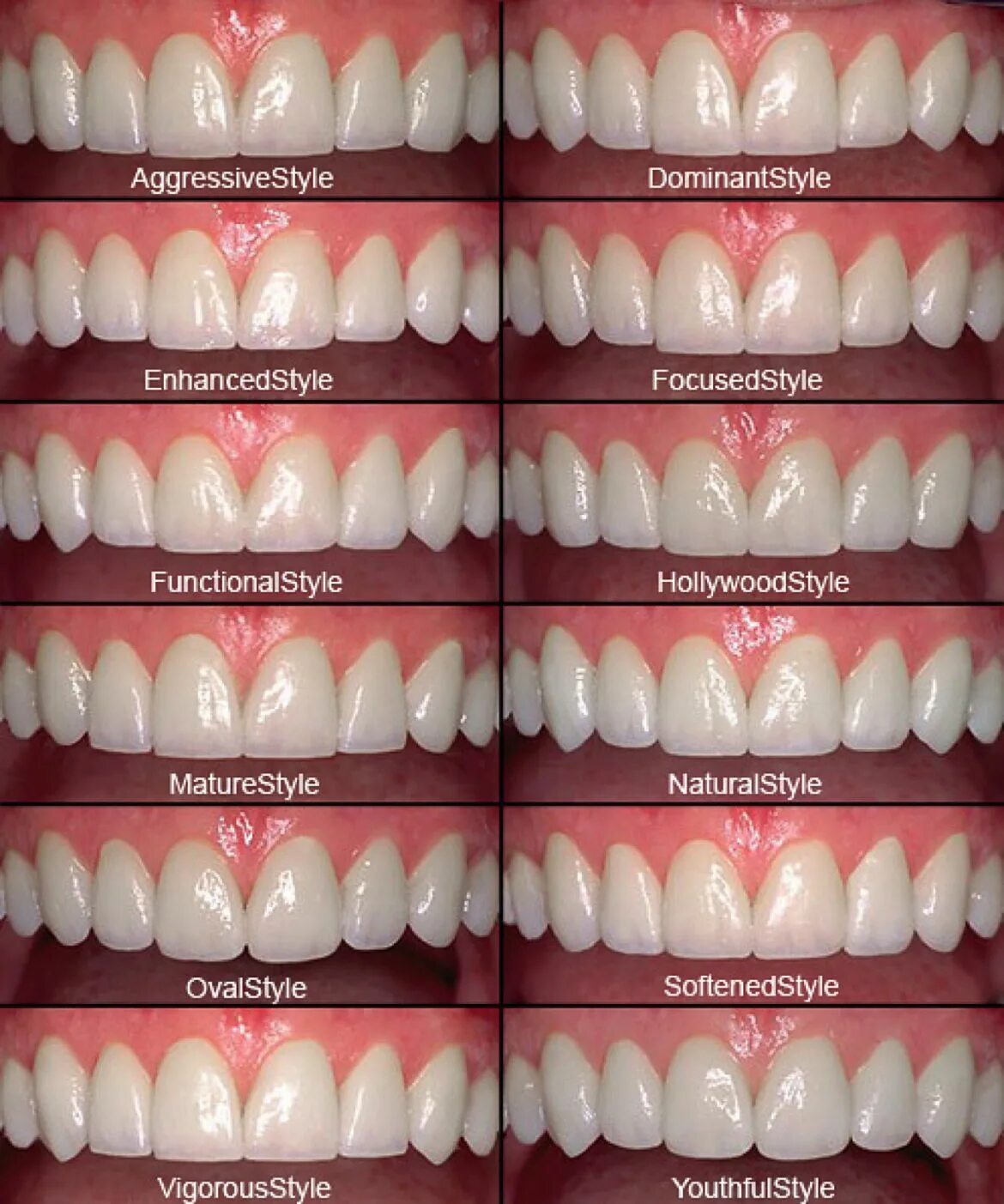 Подготовка зубов к винирам фото Porcelain Veneers for Teeth Estetica dental, Carillas dentales, Dental