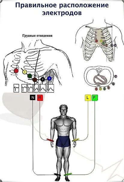 Подключение датчиков экг Экг электроды наложение по цветам на человеке