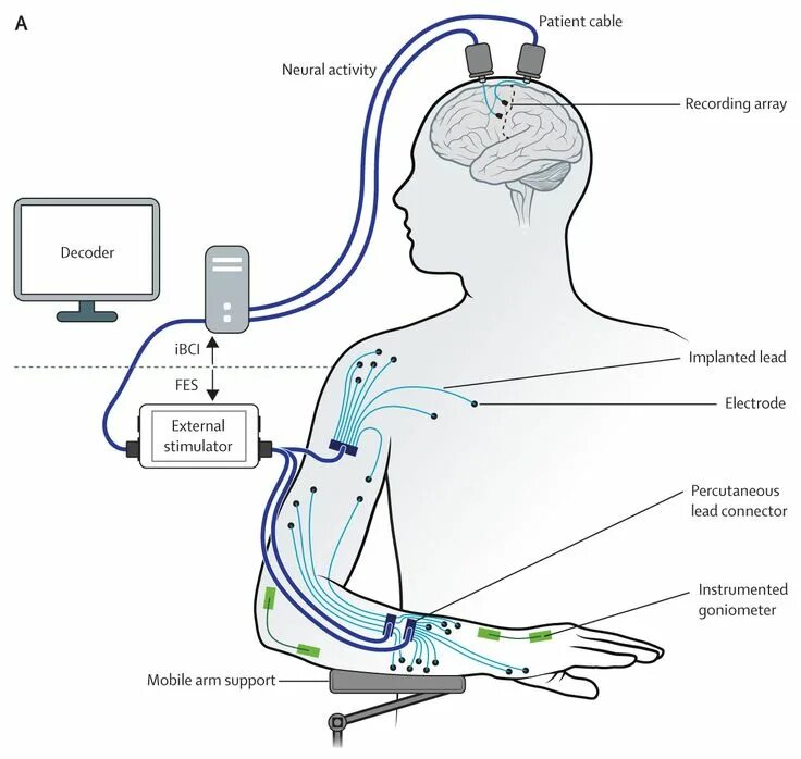 Подключение дополнительных сенсоров к нервной системе EMT técnica protagonista para que una persona con tetraplejia recupere la movili