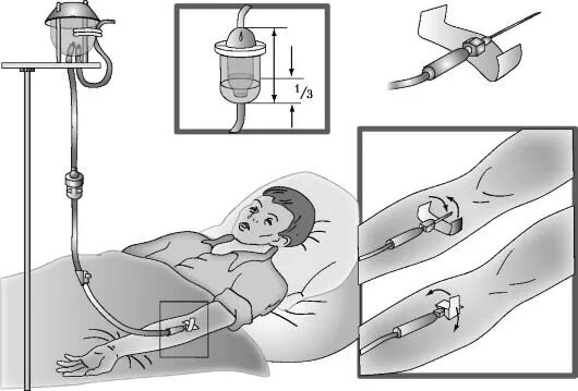 Подключение капельной системы ГЛАВА 8 ПРАВИЛА ПАРЕНТЕРАЛЬНОГО ВВЕДЕНИЯ ЛЕКАРСТВЕННЫХ СРЕДСТВ, ПЕРЕЛИВАНИЯ КРОВ