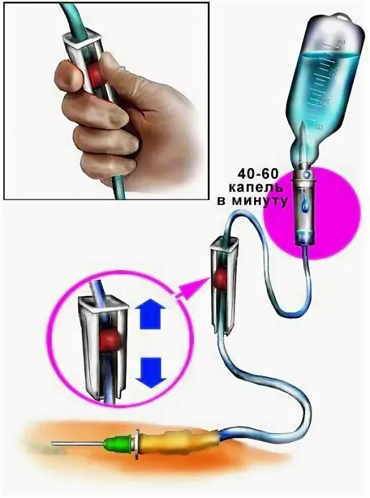 Подключение капельной системы 9.1. Внутривенное капельное вливание. Алгоритм действий при заполнении системы
