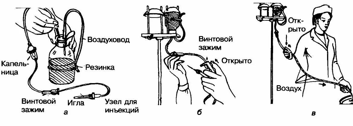 Подключение капельной системы Взаимодействие между скоростью инфузии и острым почечным повреждением (Internati