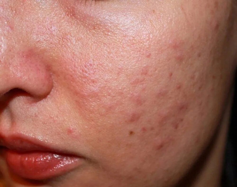 Skin problem with acne diseases, Close up woman face with dry lip mouth, Scar an