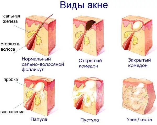 Подкожные прыщи на лице фото Акне (угри) - симптомы и лечение