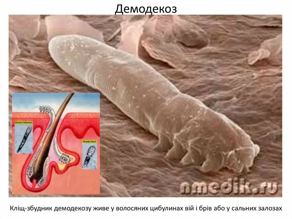 Клещ Демодекс: симптомы и лечение кожи лица