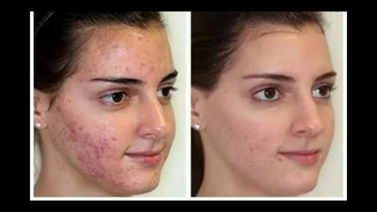 Подкожный клещ на лице фото How to treat a deep painfull pimples - YouTube