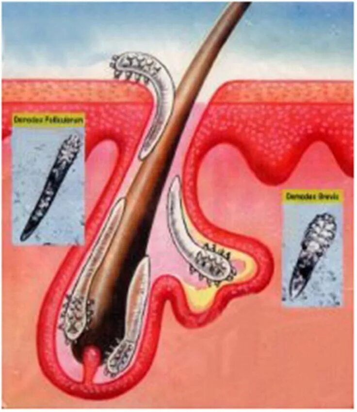 Подкожный клещ на ресницах фото A high number of people have Demodex mites without knowing it, and many patients