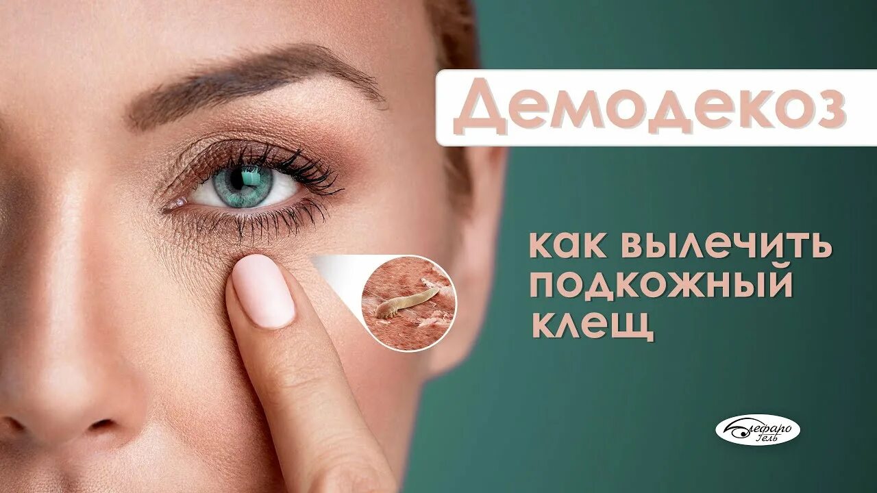 Подкожный клещ на ресницах фото ДЕМОДЕКОЗ: как распознать и избавиться от клеща - YouTube