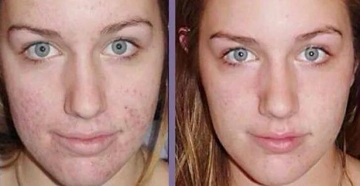 Подкожный клещ на щеках фото Pin on Beauté au naturel