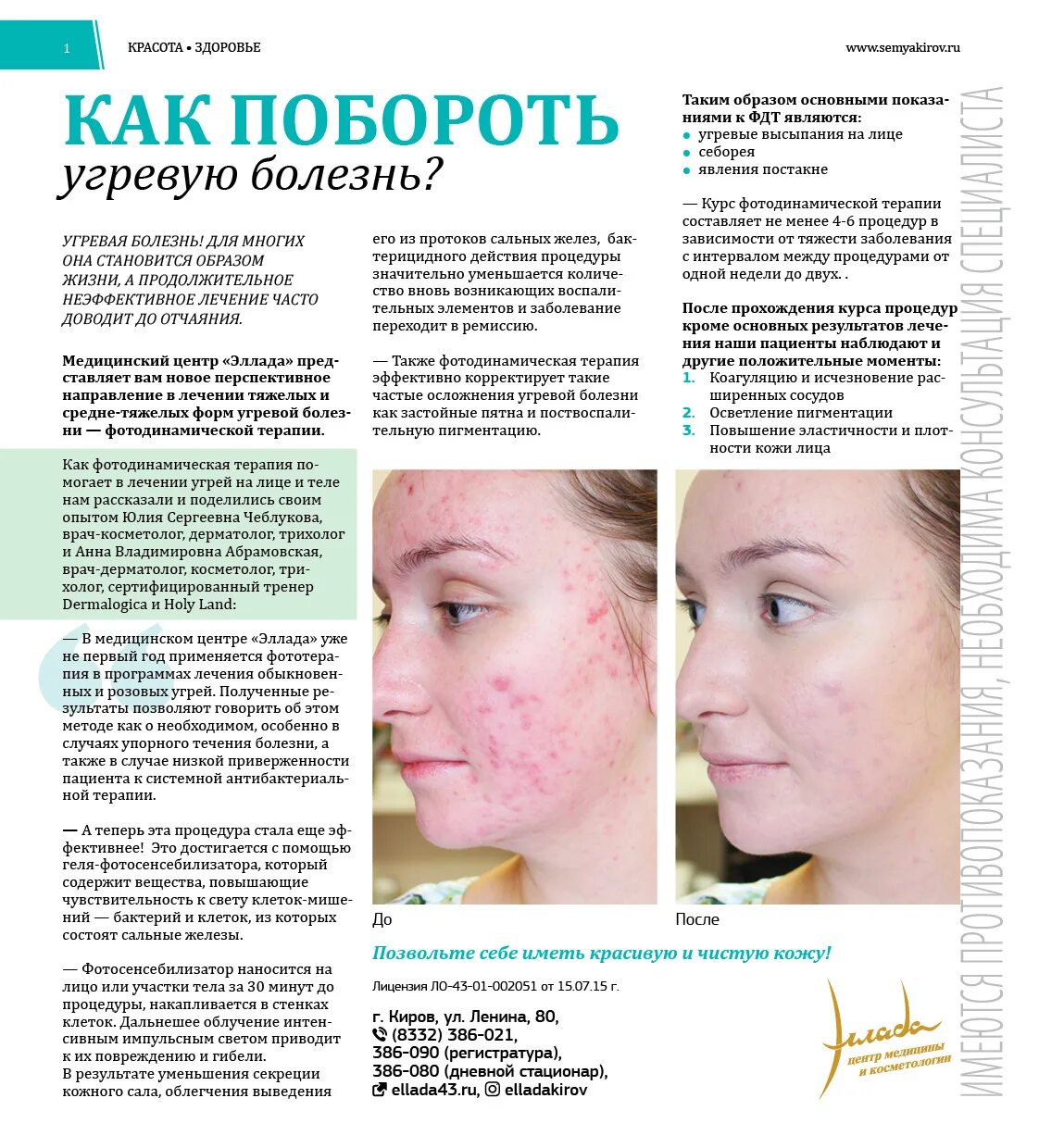 Подкожный клещ у человека фото на лице Угревая железница (Demodex) - подкожный клещ у человека: внешний вид и переносим