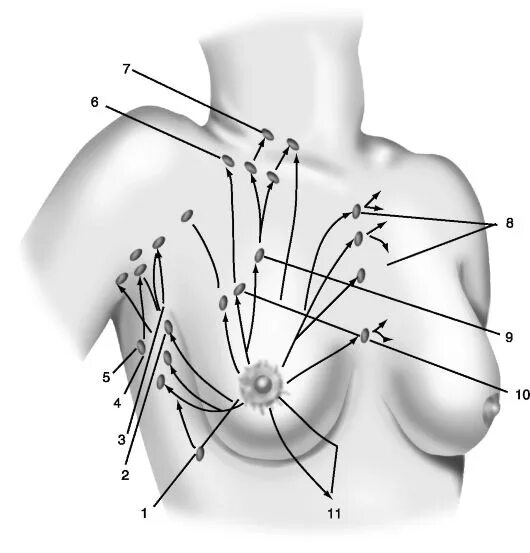 Подмышечные лимфоузлы расположение у женщин схема ГЛАВА 16 ПРЕДРАКОВЫЕ ЗАБОЛЕВАНИЯ И РАК МОЛОЧНОЙ ЖЕЛЕЗЫ
