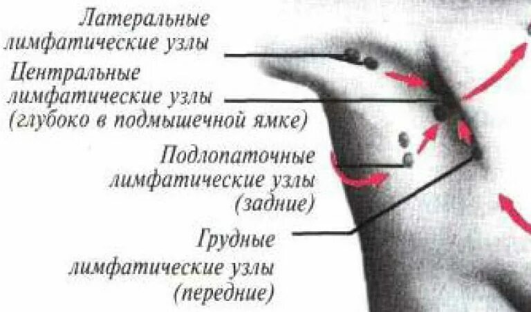 Подмышечные лимфоузлы расположение у женщин схема Боль в лимфатических узлах на шее, в ушах, подмышками