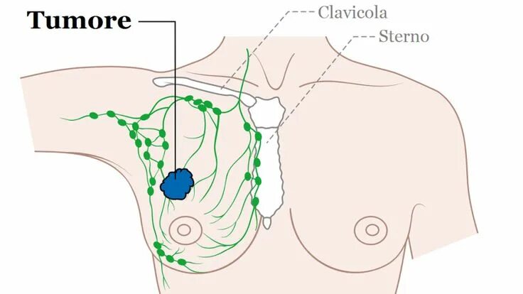 Подмышечные лимфоузлы расположение у женщин схема Proteina anticancro: la scoprono i ricercatori italiani Rimedi naturali, Rimedi 