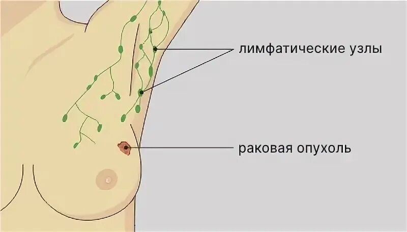 Подмышечные лимфоузлы расположение у женщин схема Лимфаденопатия (увеличение лимфатических узлов) - симптомы и лечение