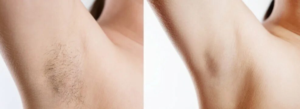 Подмышки какой лишай бывает фото Armpit Waxing Зображення - огляд 6,109 Стокові фото, векторні зображення й відео