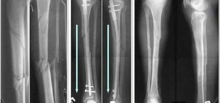 Поднадкостничная гематома большеберцовой кости фото Картинки СМЕЩЕНИЕ В МЕСТЕ ПЕРЕЛОМА