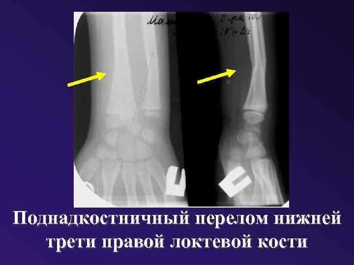 Поднадкостничный перелом лучевой кости фото Переломы у детей зеленая веточки