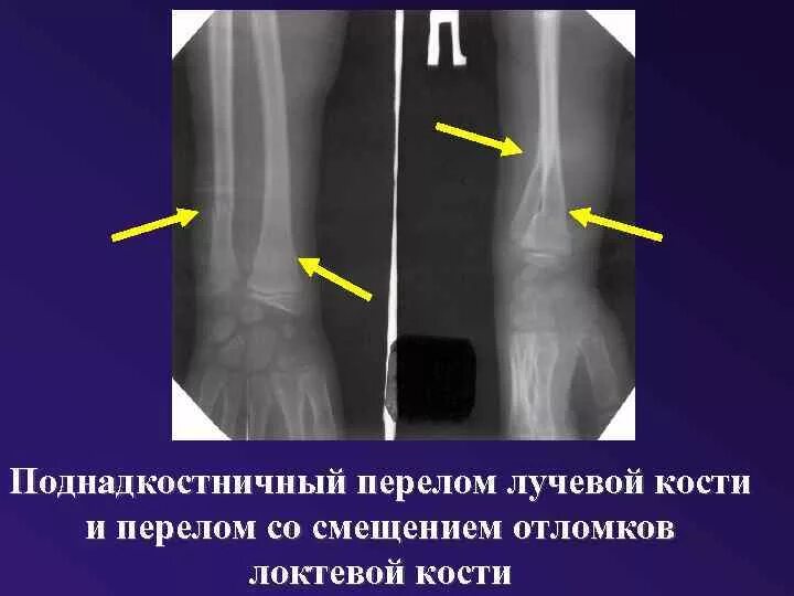 Поднадкостничный перелом лучевой кости фото ЛУЧЕВАЯ ДИАГНОСТИКА ЗАБОЛЕВАНИЙ ОПОРНОДВИГАТЕЛЬНОГО АППАРАТА Методы лучевого