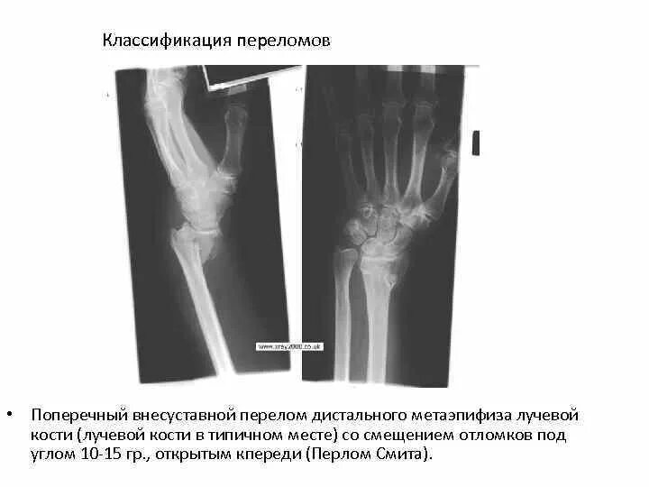 Поднадкостничный перелом лучевой кости фото Картинки ПЕРЕЛОМ МЕТАЭПИФИЗА