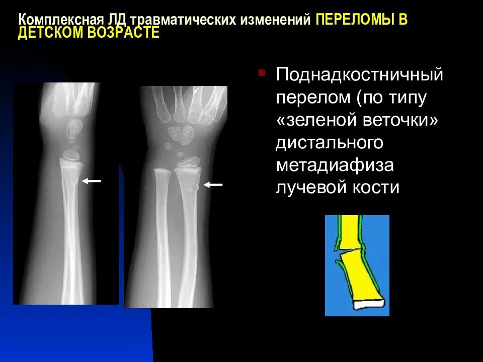 Поднадкостничный перелом лучевой кости фото Перелом диафиза лучевой кости по утвержденным ответы: найдено 82 картинок