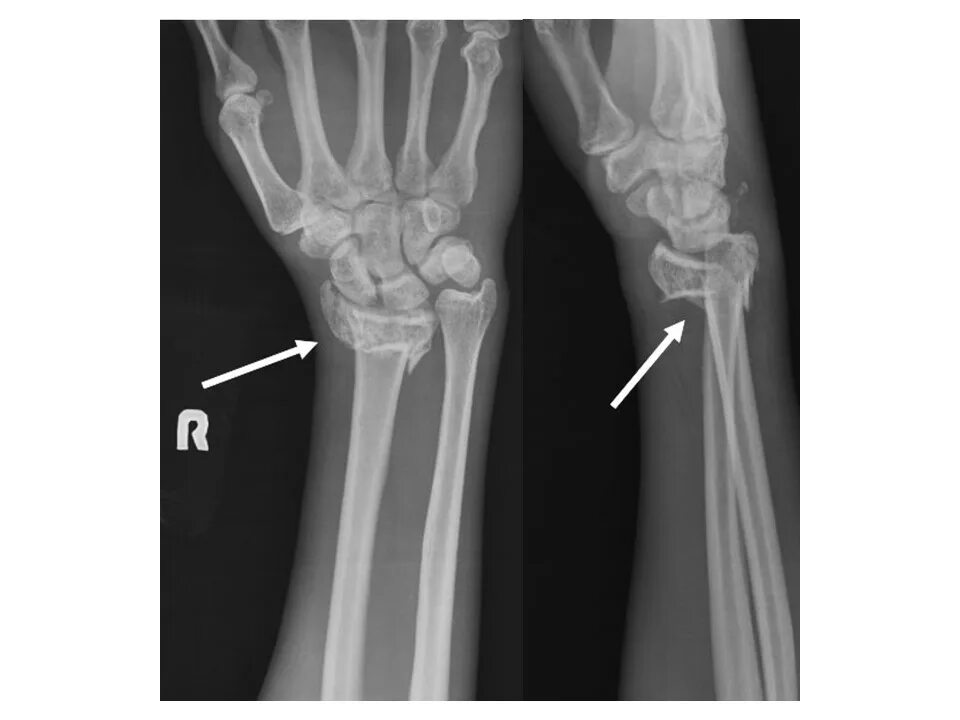 Поднадкостничный перелом лучевой кости фото Лучезапястный перелом руки со смещением