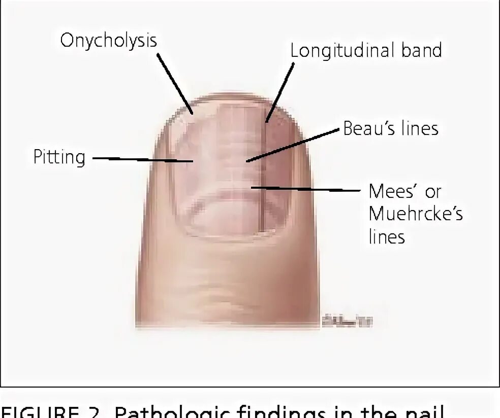 Подногтевая меланома фото на ногах начальная стадия Figure 2 from Lateral nail fold Distal edge of nail plate Anterior ligament Lunu