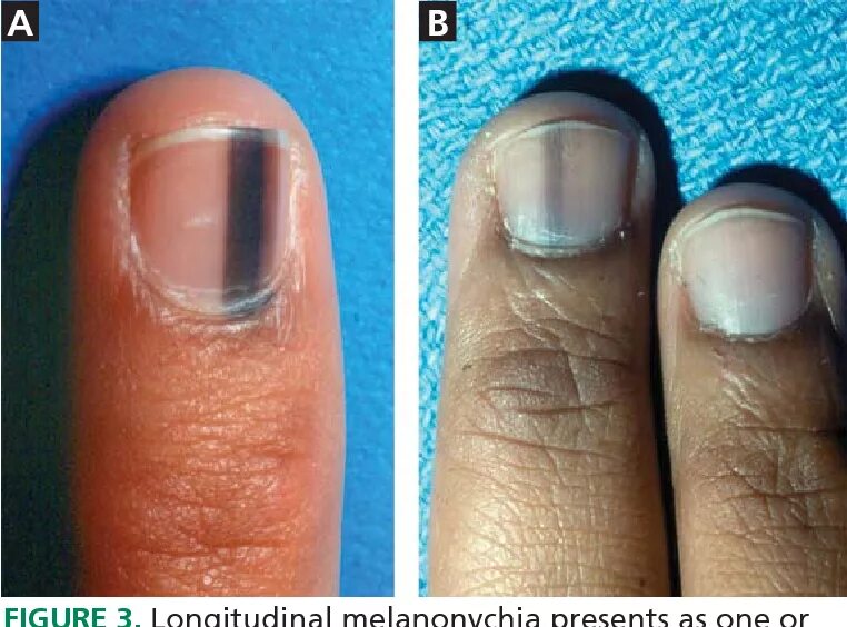 Подногтевая меланома фото первой стадии Figure 3 from Evaluation of nail lines: Color and shape hold clues Semantic Scho