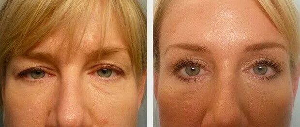 Поднять брови ботоксом фото Eyebrow botox lift