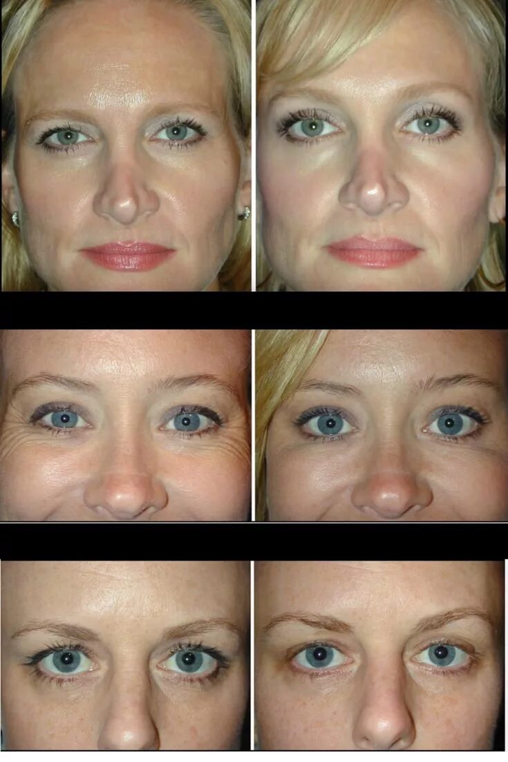 Поднять брови фото до и после Botox for an eyebrow lift? You would be amazed at the results, and how this is w