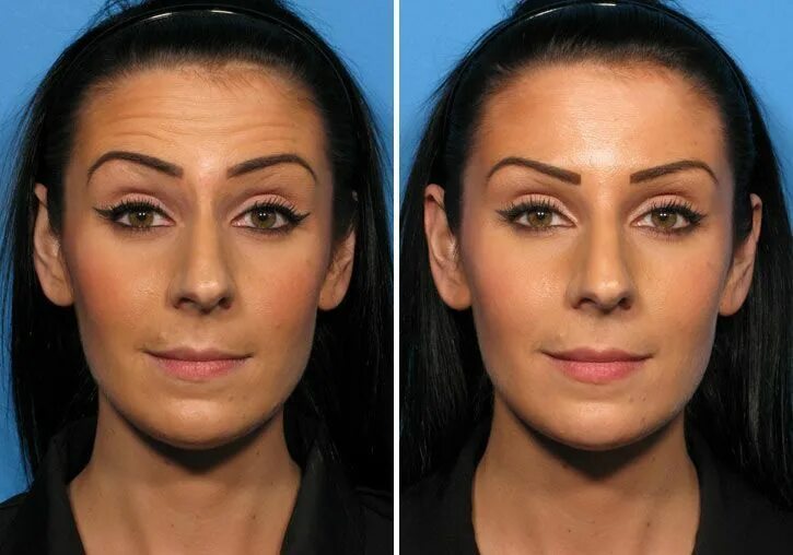 Поднять брови фото до и после botox before and after - Google Search #botoxbeforeandafter #BotoxResults Botox 