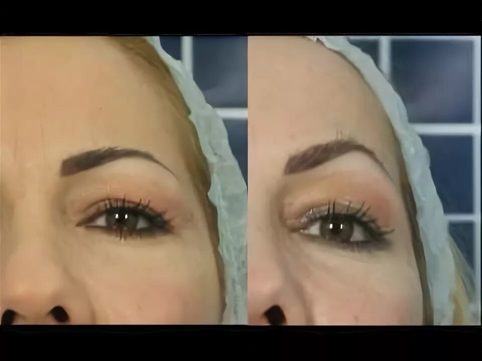 Поднять брови нитями фото Eyebrow Lift Dr Ciro Accardo - подтяжка бровей Доктор Чиро Аккардо - YouTube