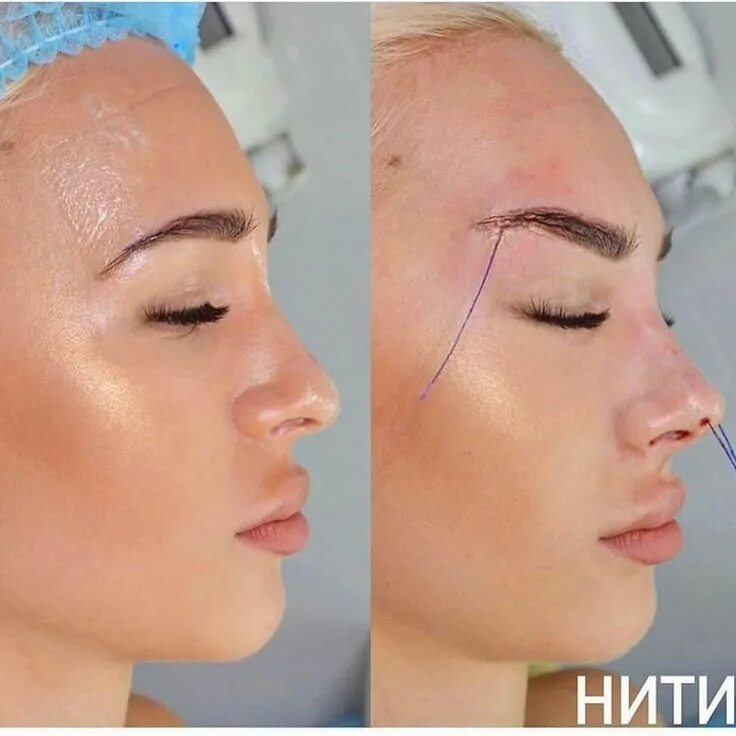 Поднять брови нитями фото до и после Achieve the 'Fox Eyes' Look with PDO Threading and Botox